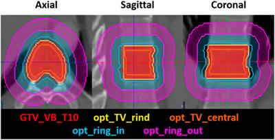 On-line adaptive and real-time intrafraction motion management of spine-SBRT on an MR-linac